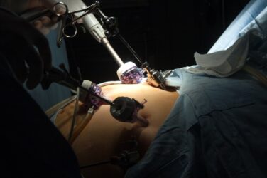 Bariatric Surgery